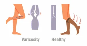 Varicose Vein Stockings For Women- March 2024