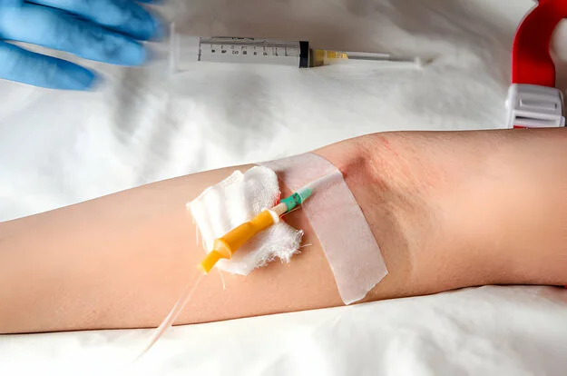 yellow color cannula